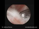 Arthroscopic Subscapularis Repair with Anthony A. Romeo, M.D., Part 2 Arthroscopic Subscapularis Repair with Anthony A. Romeo, M.D., Part 2