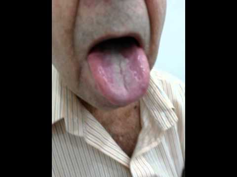 how to cure enlarged papillae