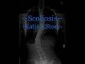 [   -   Scoliosis   -   Katie's Story   -   ]