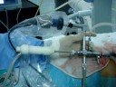 PCNL with Vibrolith PLUS video 2