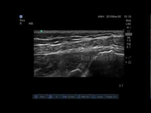 ct arthrogram shoulder labral tear
