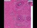 Histopathology Testis--Orchitis and epididymitis