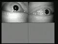 Tulsa Nystagmus 2