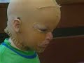 Israeli Child burned By molotov Coctail