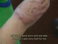 Israeli Child burned By molotov Coctail