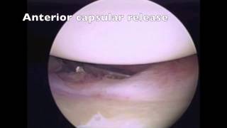 Arthroscopic stiff shoulder