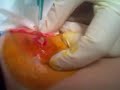 River of puss FTW (Abscess Draining)