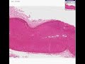 Histopathology Adrenal gland --Amyloidosis