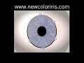 Permanently Change your Eye Color NewColorIris Permanently Change your Eye Color NewColorIris