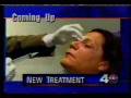 botox-laser-wrinkles
