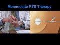 MammoSite Radiation Therapy for Breast Cancer MammoSite Radiation Therapy for Breast Cancer