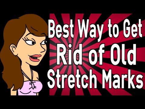 how to eliminate old stretch marks
