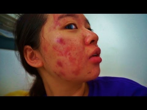 My Acne Story - 18th Week of Accutane
