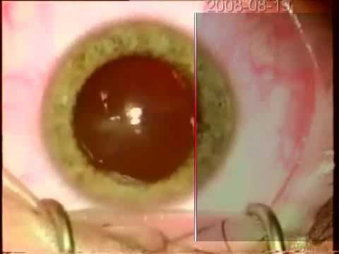 My ICL-surgery