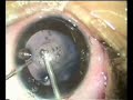 Congenital cataract with deficient posterior capsule Congenital cataract with deficient posterior capsule