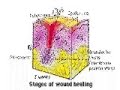 Stages of  wound healing