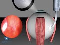 Scleral Buckling: Cryotherapy VR1 Basic Techniques
