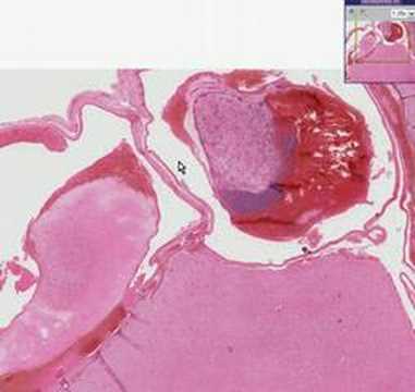 arteriovenous fistula ppt