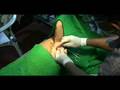 Upadhya Method of Dog Spaying
