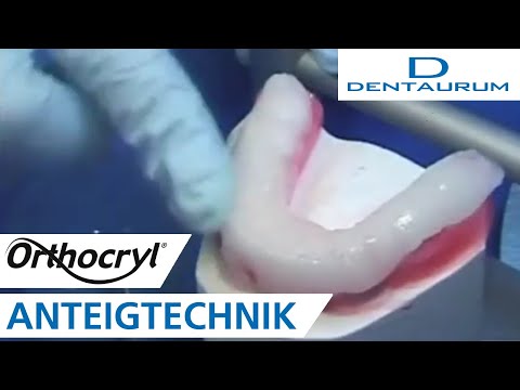 Aufbissschiene in der Anteigtechnik