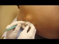 monster pimple - übertriebener monster pickel - büyük sivilce !!!!!!!!!!!!!