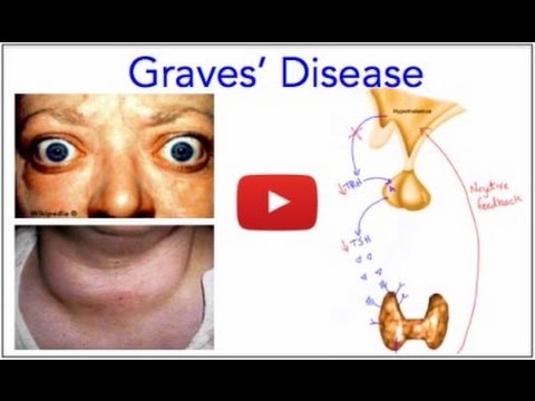 how to cure graves disease