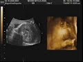 3D Ultrasound