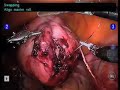 Robotic Myomectomy --conducted by Dr. Michael Pitter