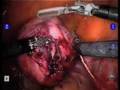 Robotic Myomectomy --conducted by Dr. Michael Pitter