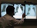 RADIOLOGIA TORAX