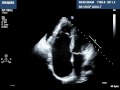 Ebstein's Anomaly