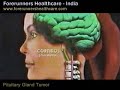 Pituitary gland cancer treatment in India with expertise and high quality health care