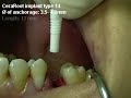 CeraRoot Zirconia Dental Implant Surgery (upper bicuspid)