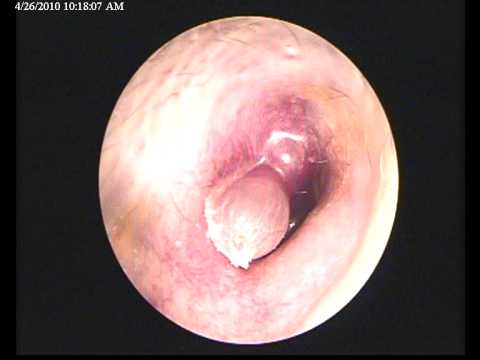 Glomus Tympanicum: A Pulsating Mass in the External Auditory Meatus