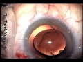 Cut Trailing haptic Explanted and reimplanted