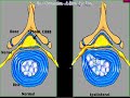 Lumbar Training Part 5 Dr Matthew Brown Chelsanna Systems.wmv