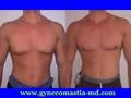 new york male breast reduction surgery