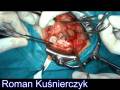 Femoral Hernia- Przepuklina Udowa- Kuśnierczyk