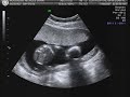 We got curious about what our son does when we play Quran to him in the womb. Here's what we were surprised to find.  You will see how active he was before the Quran was recited to him. A fetus prostrates to God (Allah s.w.t) at the sound of the Quran. Another proof of how Islam (Submission to God) is our natural state.جنين يسجد عند سماع القرآنMiracles of Quran. Creation and evolution. Embryology. Islam and science. Miracles of the Quran.معجزة قرآن اسلام الله الصلاة سجود الخلق