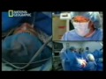 Cirugia de cambio de sexo (Transexualismo) - Vìdeo Dailymotion2.mp4