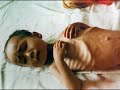 Starving Children