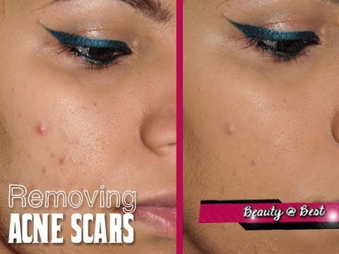 how to remove acne scars in a natural way