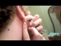 Nasty Projectile Face Pus Pimple Pop