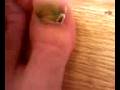 gross toenail.3g2