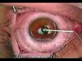 LASIK - Operação LASIK - Operação