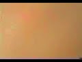 LASIK - Operação