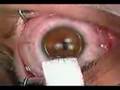 LASIK - Opera&Atilde;&sect;&Atilde;&pound;o