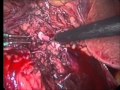 The Renal Hilum - The Use Of Polymer Clips The Renal Hilum - The Use Of Polymer Clips