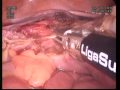 9223GYN 'Transumbilical' Laparoscopic Hysterectomy Using the Ligasure Device: Initial Experience...