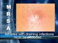 What wrestlers need to know about MRSA, Methicillin Resistant Staphylococcus aureus skin infection.